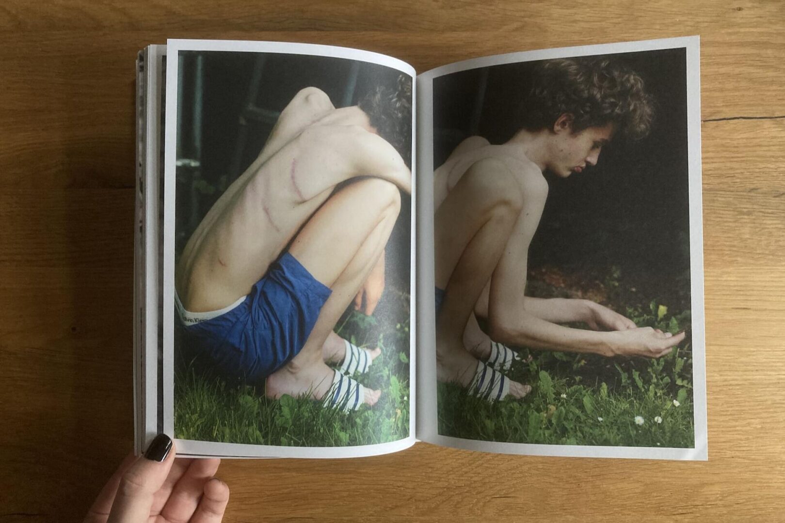 Open book showing two photos of a thin person with short hair, sitting curled up on grass, wearing blue shorts. A large scar is visible on their back. The background is outdoors with greenery.